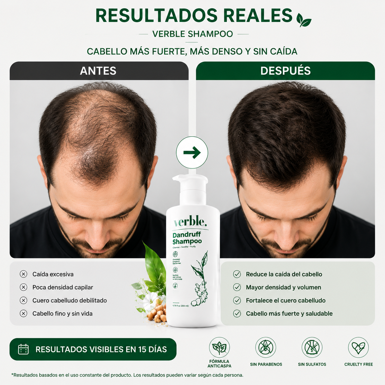 Verbel Dandruff -  Shampoo dermatológico 100% Efectivo.